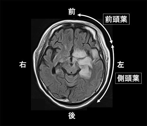 単純ヘルペス脳炎の頭部MRI