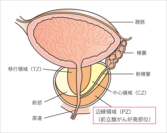 前立腺の位置と前立腺がんの好発部位