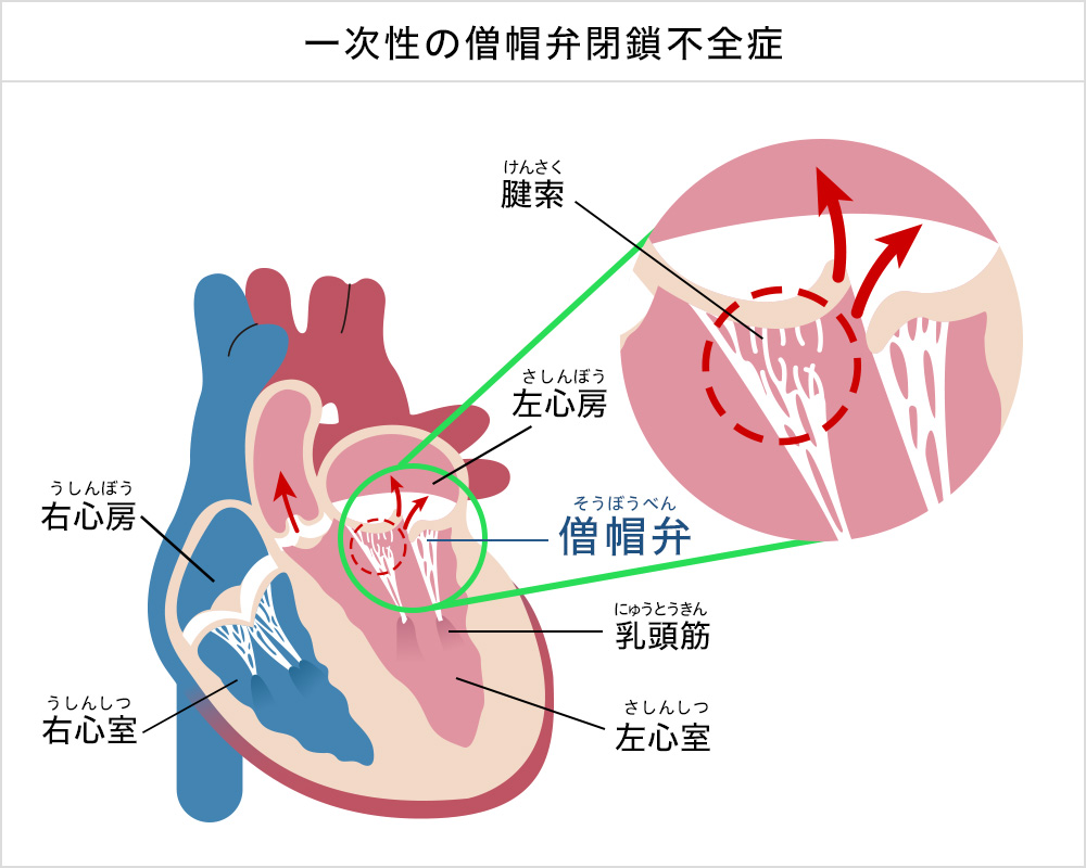 一次性の僧帽弁閉鎖不全症