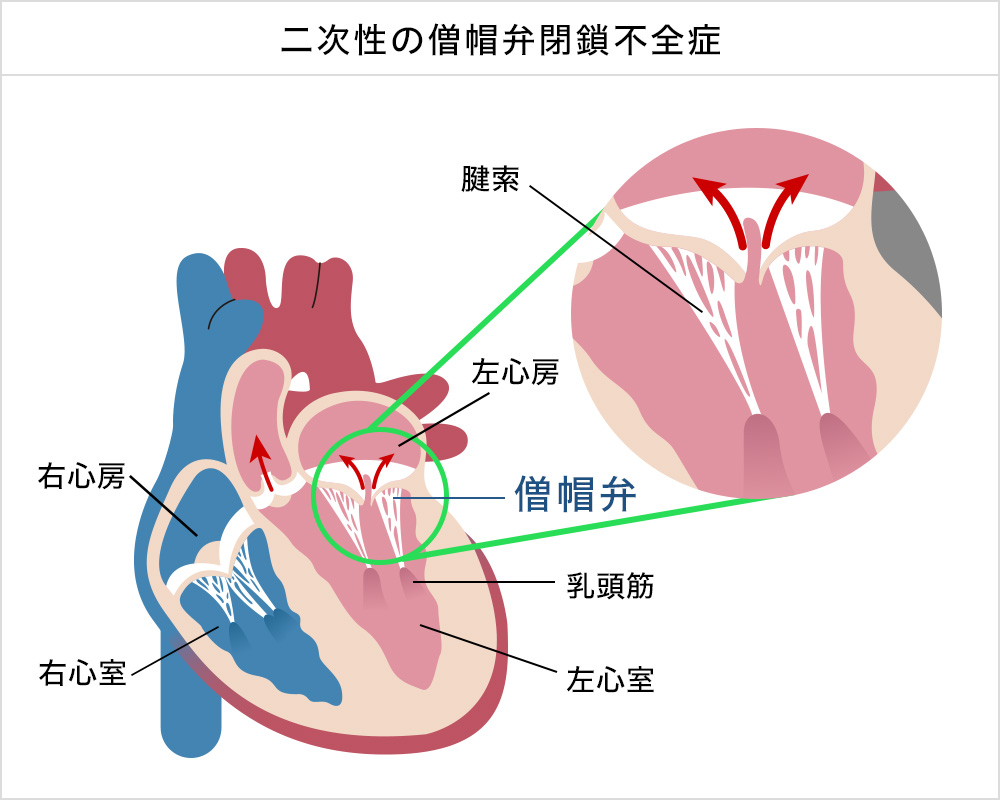 二次性の僧帽弁閉鎖不全症