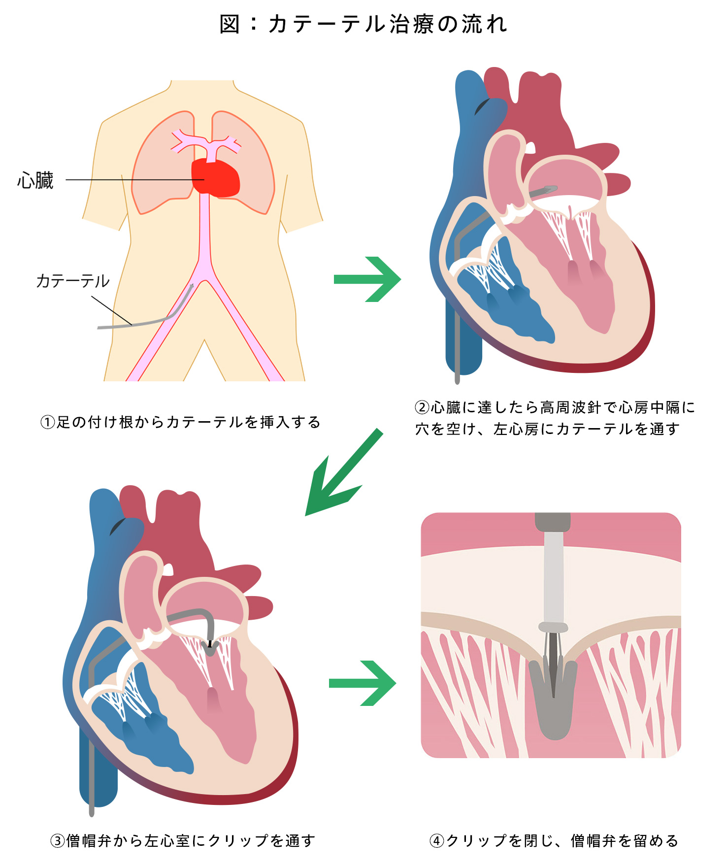 カテーテル治療の流れ