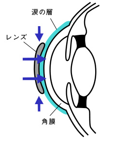 ハードレンズ