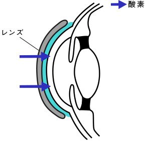 ソフトレンズ