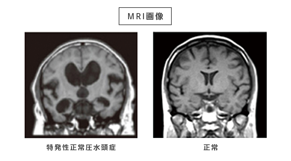 MRI画像