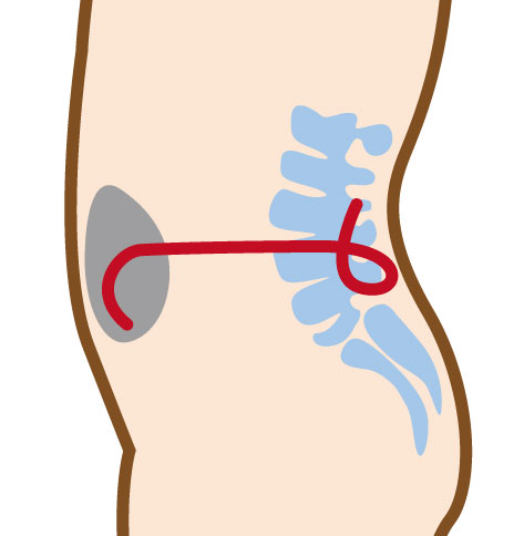 腰椎-腹腔シャント