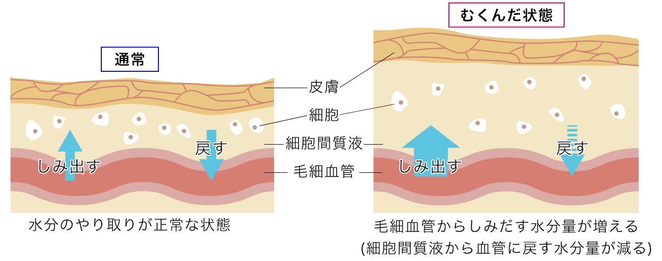 実は病気のサインかも？いろいろなむくみ | 済生会