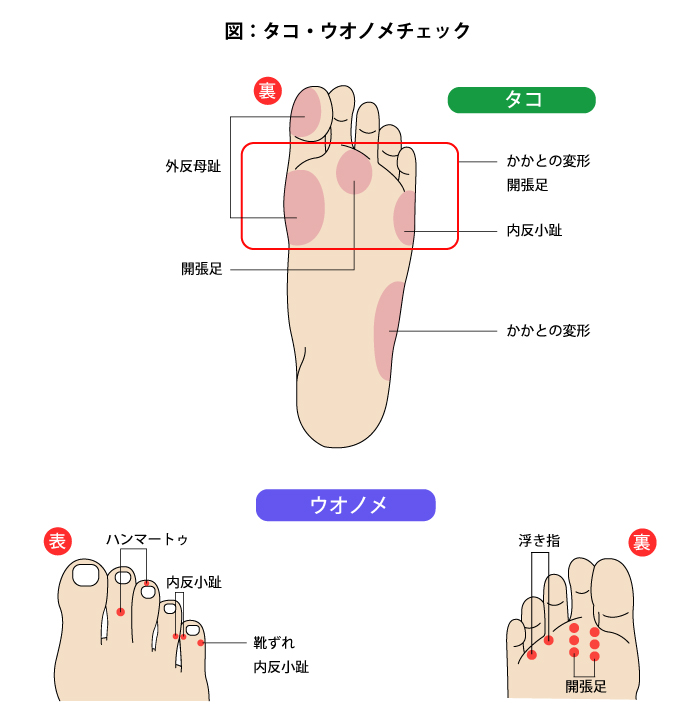 が 痛い 足 の 裏側