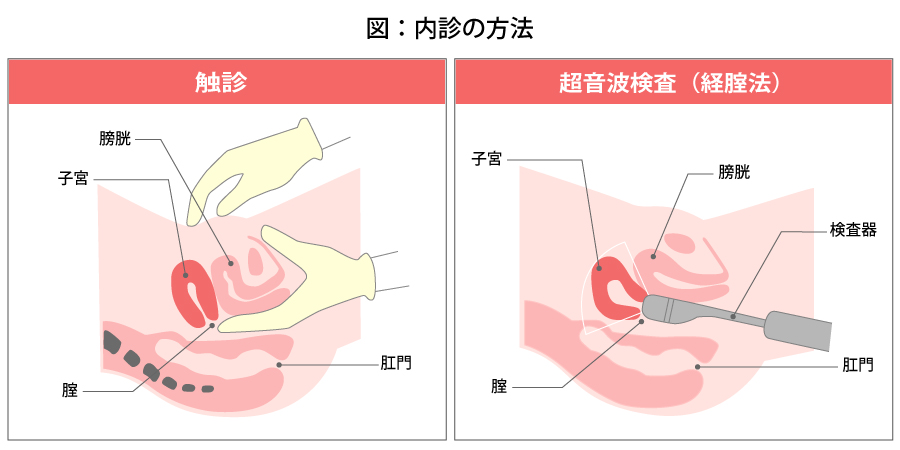 内診 