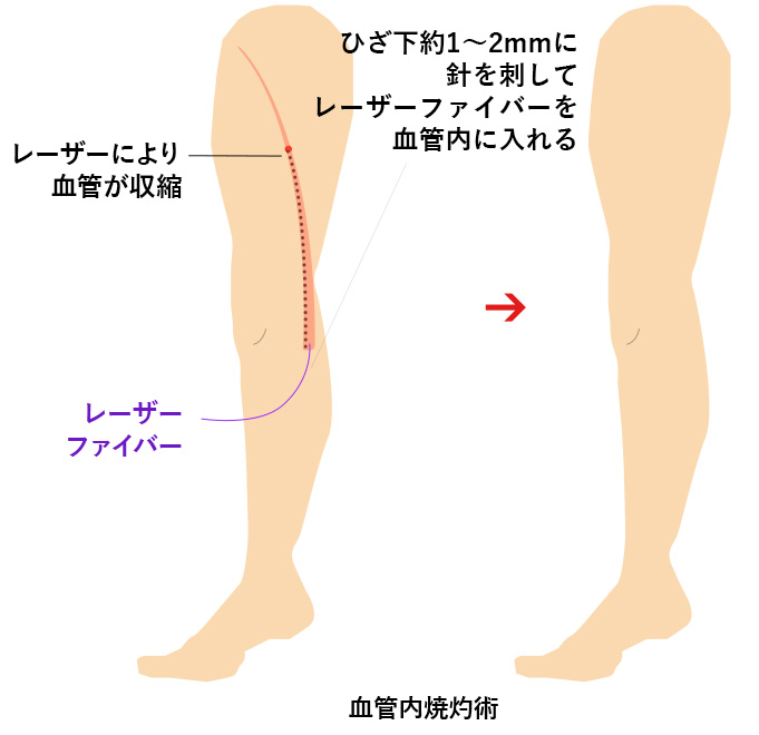 血管内焼灼術