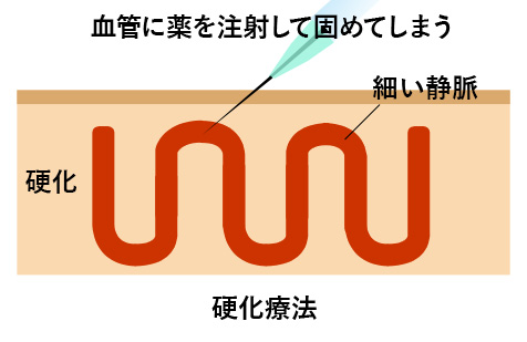 硬化療法