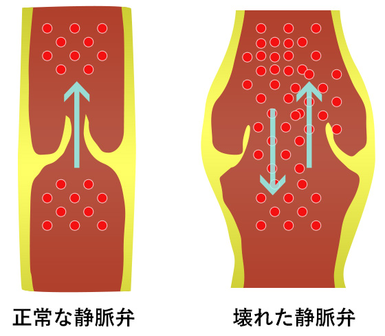 静脈弁