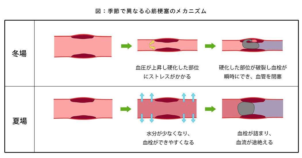 季節で異なる心筋梗塞のメカニズム