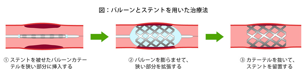 バルーンとステントを用いた治療法