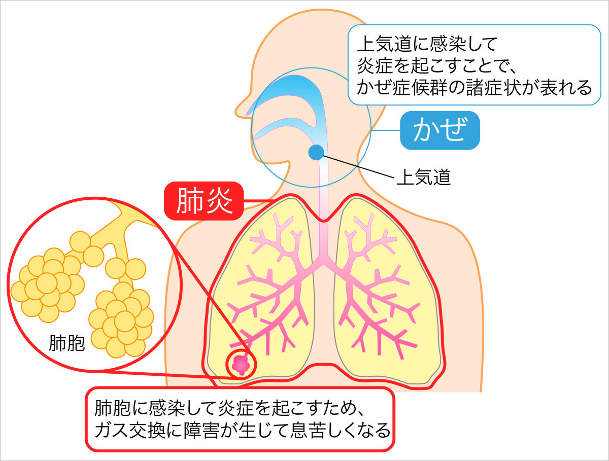 急性 上 気道 炎 コロナ