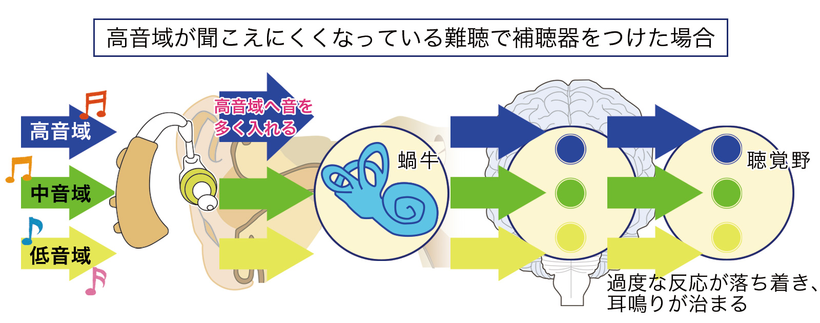 高音域が聞こえにくくなっている難聴で補聴器をつけた場合