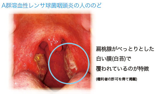 A群溶血性レンサ球菌咽頭炎の人ののど