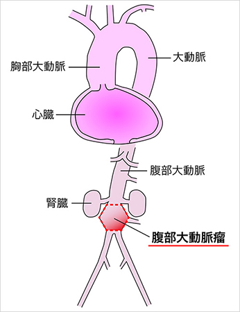 腹部大動脈瘤の位置