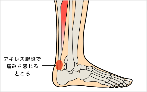 アキレス腱 揉む と 痛い