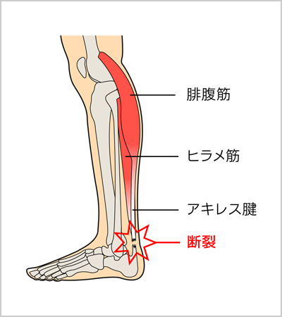 アキレス腱断裂 (あきれすけんだんれつ) | 済生会