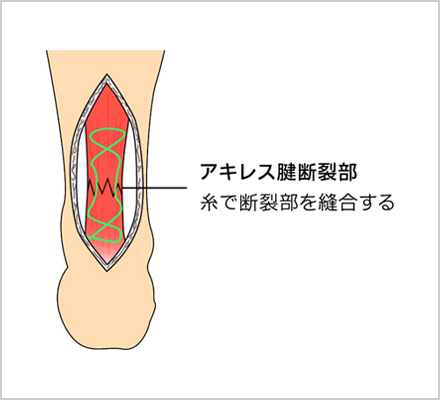 アキレス腱縫合による手術療法