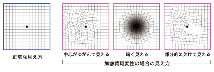 アムスラー検査