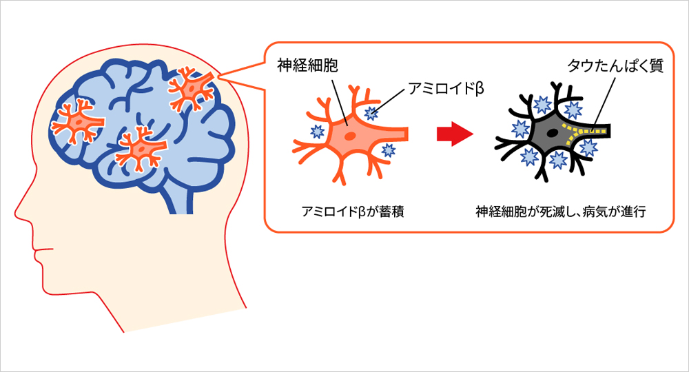 症 認知 アルツハイマー 型 【かんたん解説】アルツハイマー型認知症とは？原因と症状・治療法まで｜LIFULL介護(旧HOME'S介護)