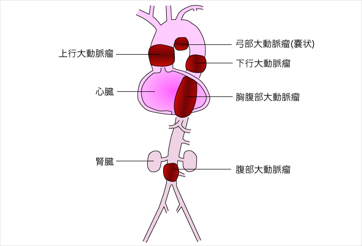 大動脈瘤の部位による分類