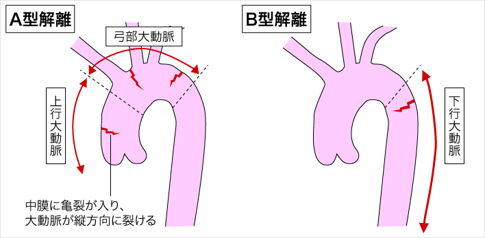 大動脈解離の分類