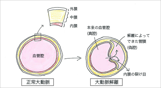大動脈の構造と大動脈解離