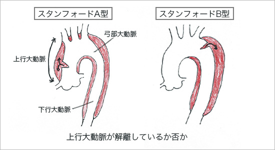 スタンフォードA型とB型の違い