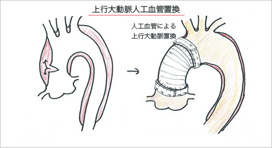 スタンフォードA型解離の手術治療(1)