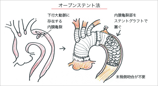 スタンフォードA型解離の手術治療(2)