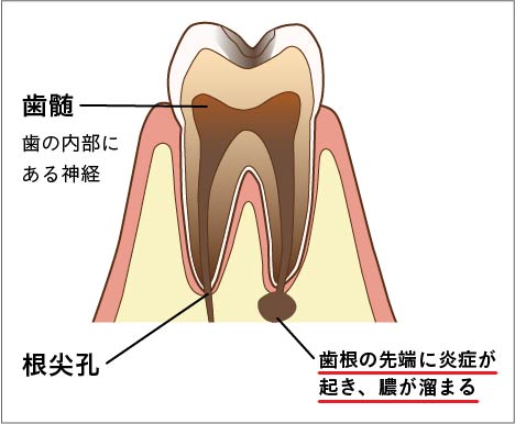 根尖性歯周炎 (こんせんせいししゅうえん)とは | 済生会