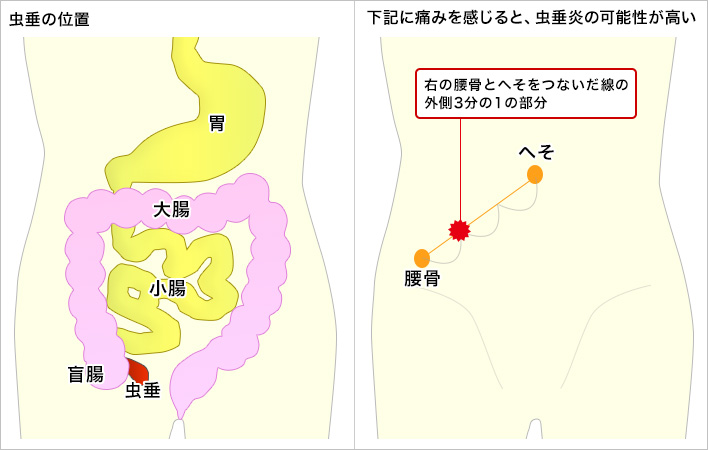 位置 盲腸 盲腸の痛みの位置や場所は?位置は左!卵巣の近く!腰や背中にも症状が出る!