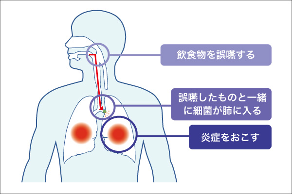 誤嚥性肺炎 ごえんせいはいえん 済生会