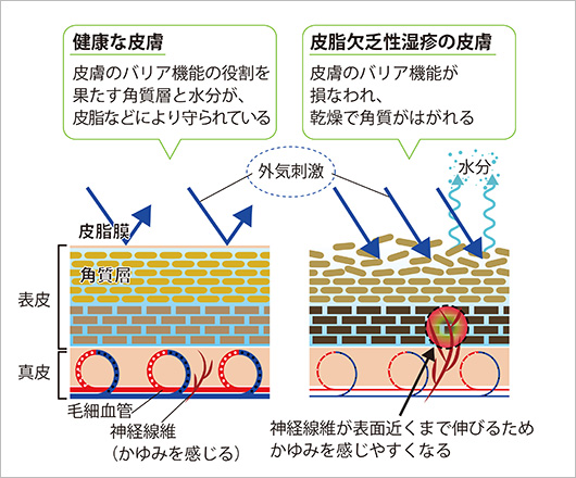 健康な皮膚と皮脂欠乏性湿疹