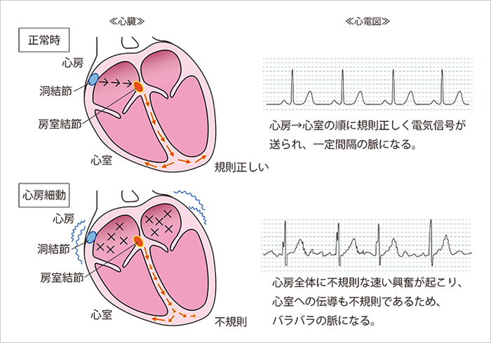 心房 細 動 発作 性