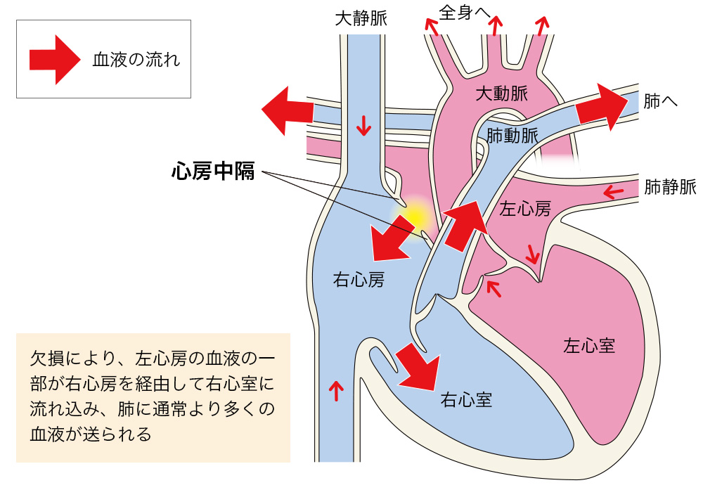 心房中隔欠損症