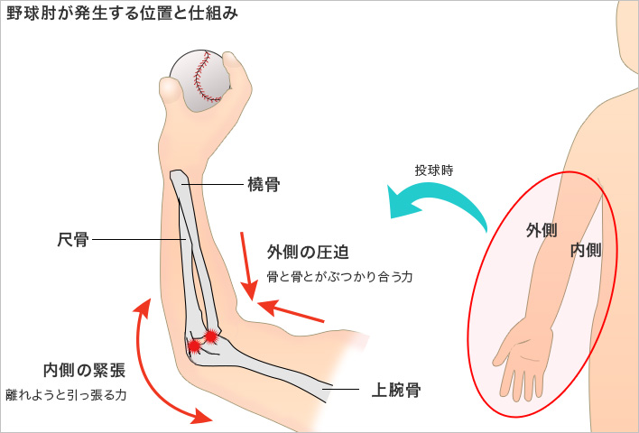 野球肘が発生する仕組みと位置