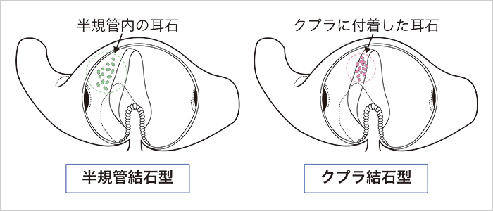 半規管結石型とクプラ結石型の膨大部内の様子