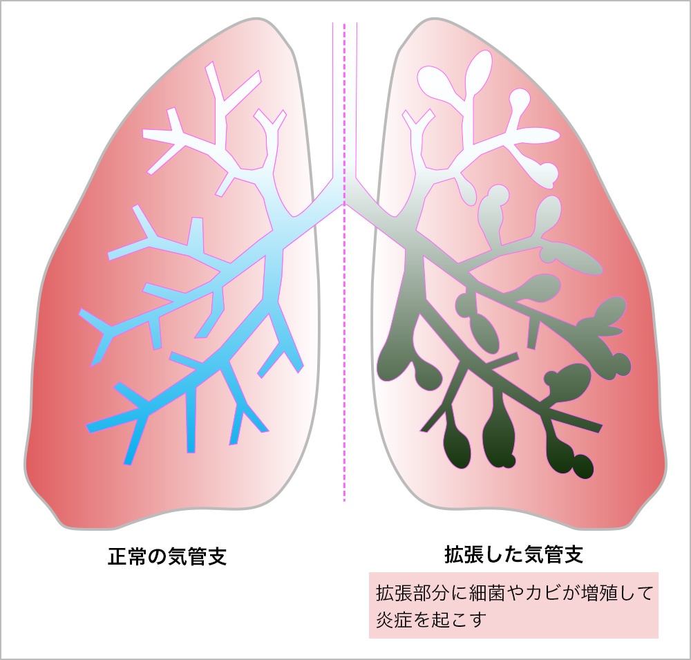 たん に 血 が 混じる