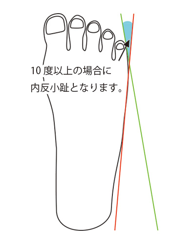 内反小趾 ないはんしょうし 済生会