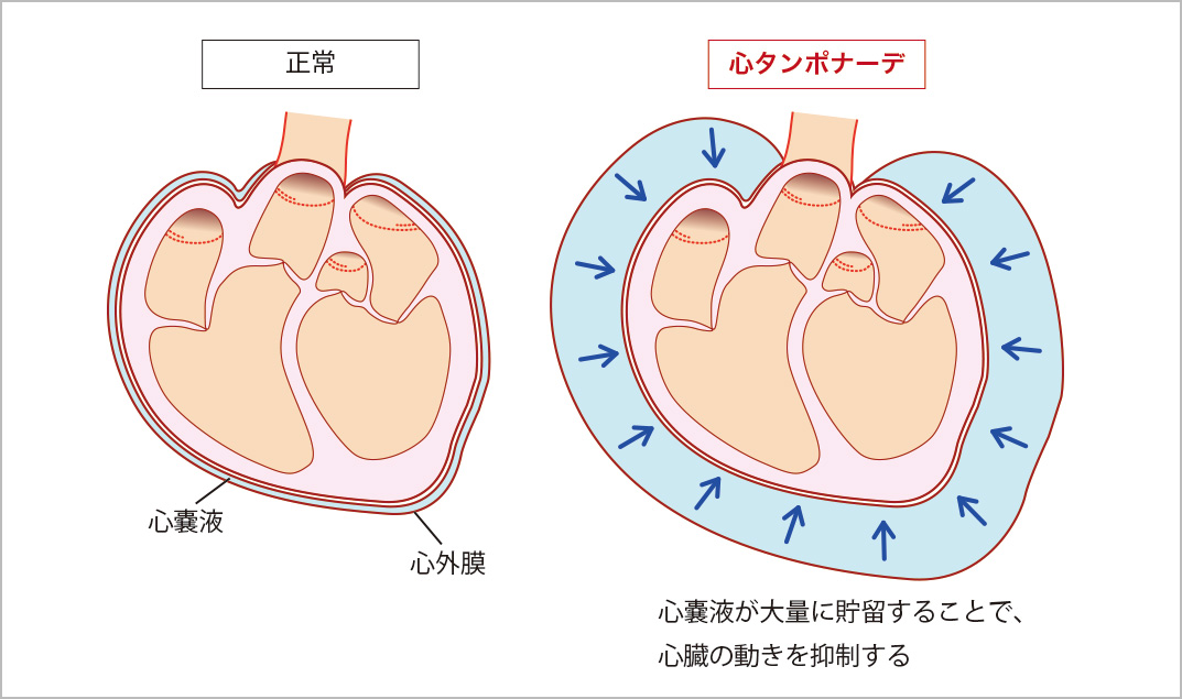 心臓 に 水