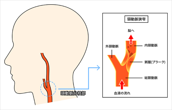 頸 動脈 押す と 痛い