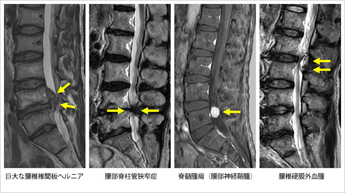 馬尾症候群の原疾患とそのMRI画像