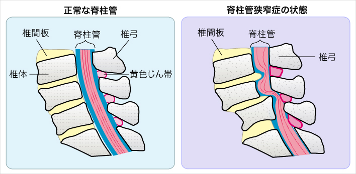 脊柱管狭窄症の状態