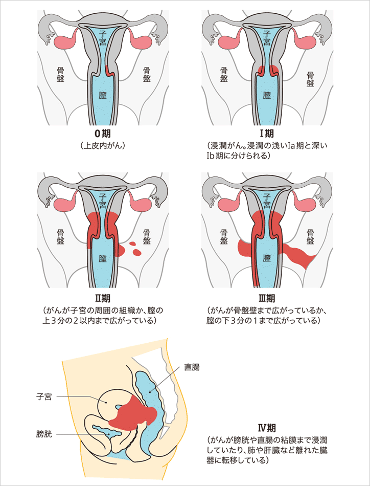 ん 子宮 頚 が 子宮頸がん 治療：[国立がん研究センター