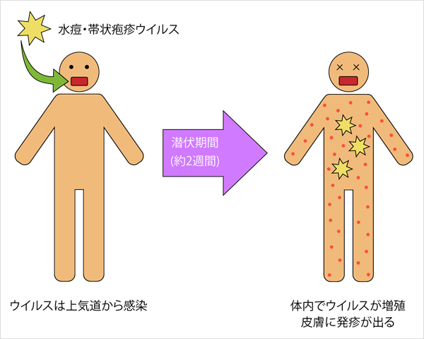 帯状 疱疹 経過