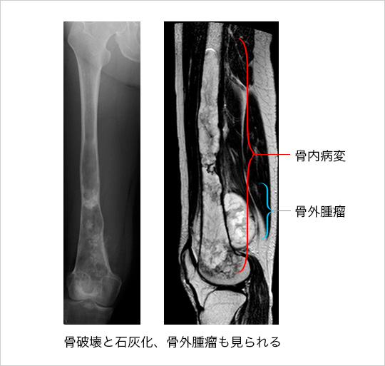 軟骨肉腫(大腿骨)