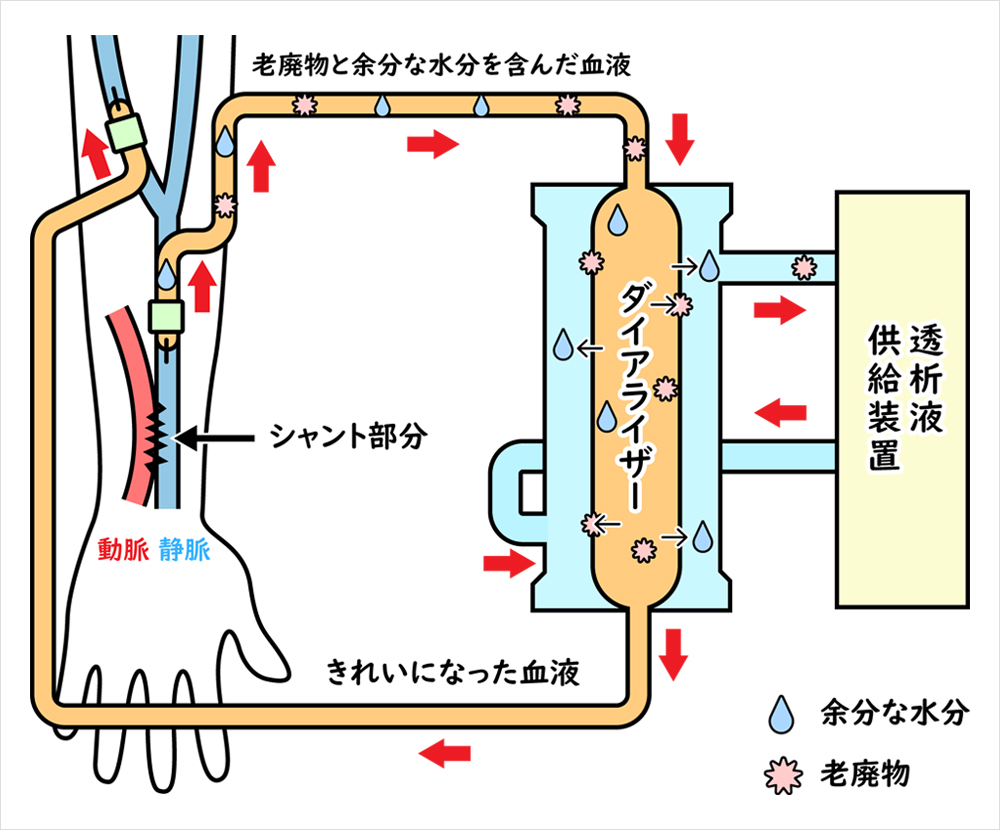 血液透析